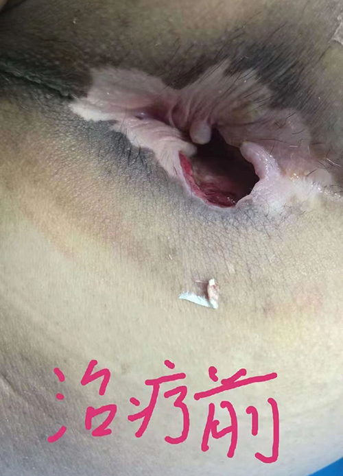 伤口愈合前