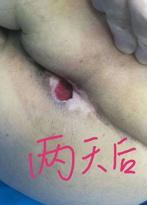 伤口愈合后